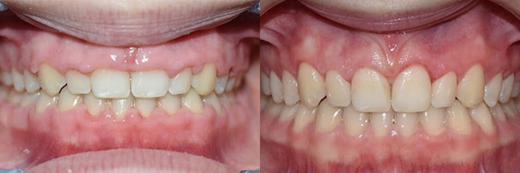 patient before and after
