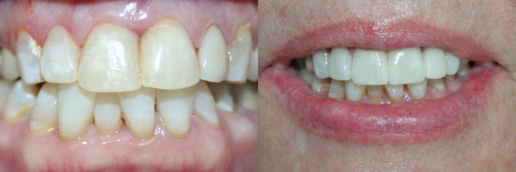 patient before and after